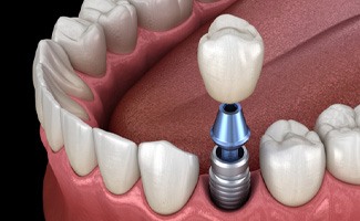 : a digital illustration depicting an implant crown