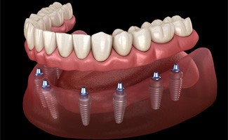 a digital illustration depicting an implant denture