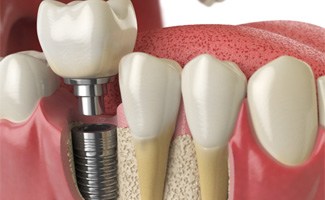 a digital illustration showing how a dental implant works