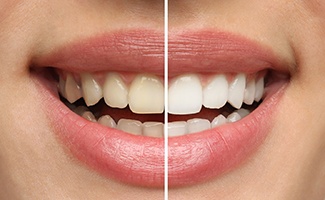 Closeup of patient's smile before and after teeth whitening